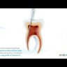 Endostar E3 endodontijas instruments 2.